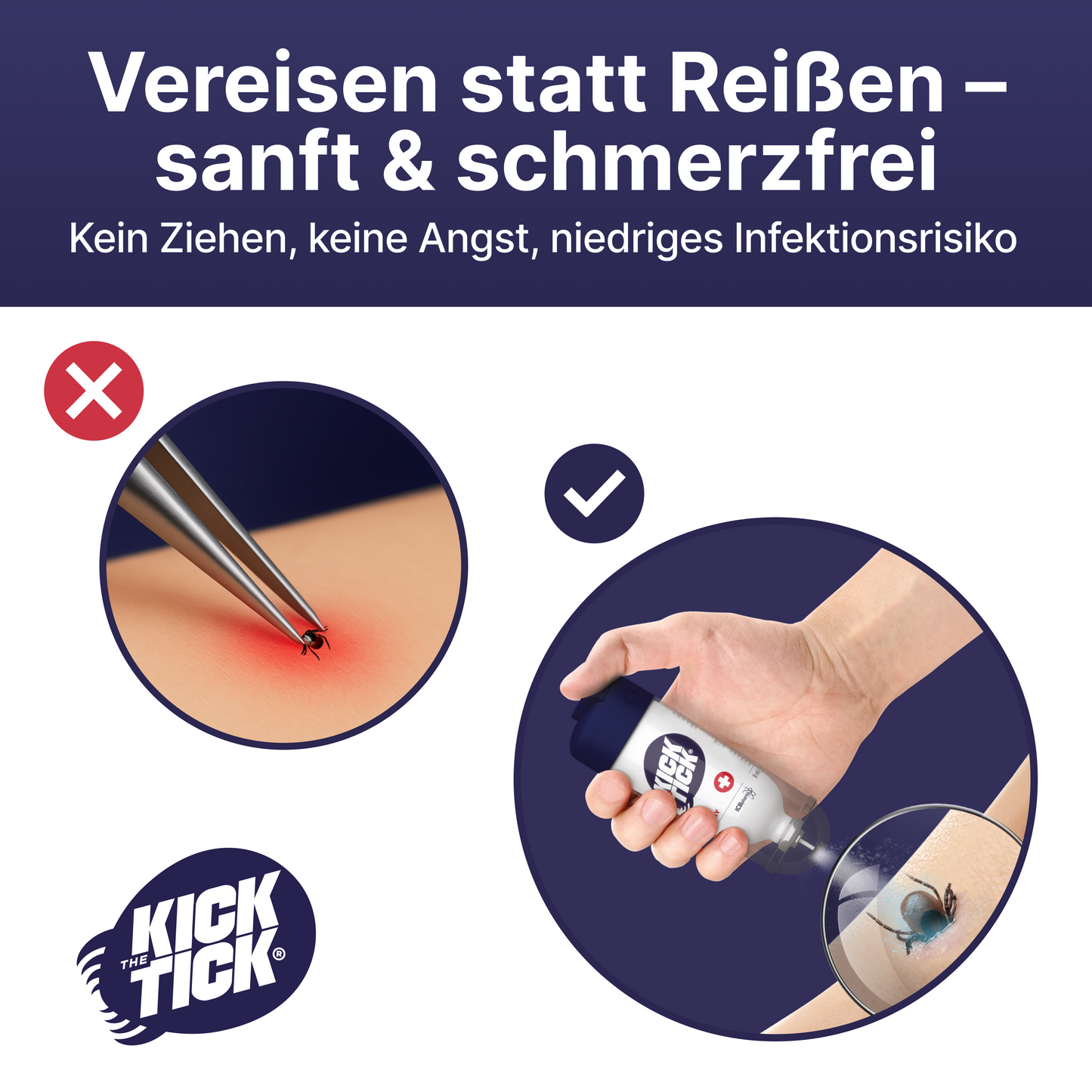KICK THE TICK | Schmerzfreies & Sicheres Zeckenentferner Set mit Vereisungsspray und Zeckenzange